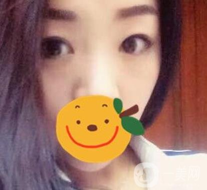 昆明市第一人民醫(yī)院雙眼皮多少錢？附案例及2020全新整形價(jià)格表