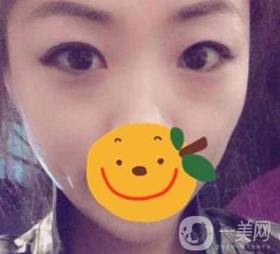 昆明市第一人民醫(yī)院雙眼皮多少錢？附案例及2020全新整形價(jià)格表