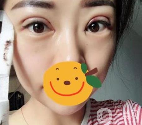 昆明市第一人民醫(yī)院雙眼皮多少錢？附案例及2020全新整形價(jià)格表