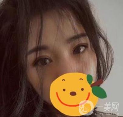 昆明市第一人民醫(yī)院雙眼皮多少錢？附案例及2020全新整形價(jià)格表