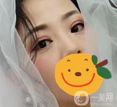 昆明市第一人民醫(yī)院雙眼皮多少錢？附案例及2020全新整形價(jià)格表