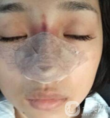 上海王輝醫(yī)生隆鼻