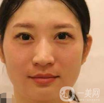 武漢隆鼻醫(yī) 趙星星