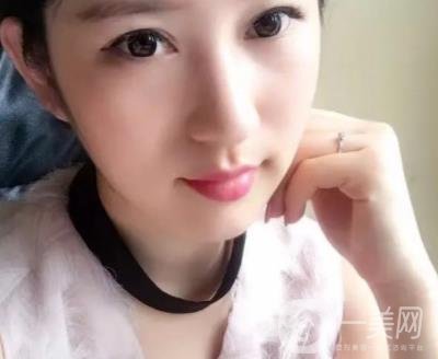 武漢隆鼻醫(yī) 趙星星