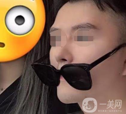 邱健欽醫(yī)生隆鼻