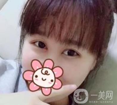 上海華美楊亞益做眼睛多少錢？價格表及案例詳情