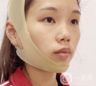 上海時光醫(yī)院何晉龍磨骨怎么樣？價格表及術后*果分享