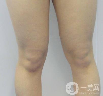 中南大學(xué)第一醫(yī)院整形美容科價(jià)格表*新發(fā)布,附全身吸脂*果分享