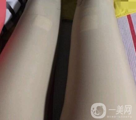 中南大學(xué)第一醫(yī)院整形美容科價(jià)格表*新發(fā)布,附全身吸脂*果分享