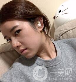 鹽城東方女子整形醫(yī)院價(jià)格表明細(xì)，附隆鼻案例