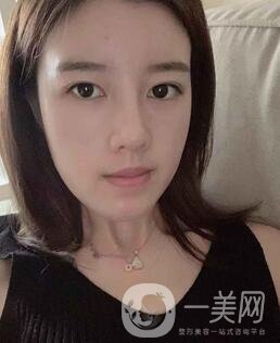 鹽城東方女子整形醫(yī)院價(jià)格表明細(xì)，附隆鼻案例