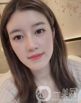 鹽城東方女子整形醫(yī)院價(jià)格表明細(xì)，附隆鼻案例