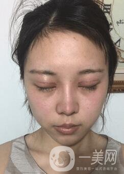 蘭大二院整形外科價(jià)格表2020，附雙眼皮整形日記