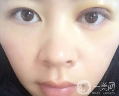 河南省立眼科醫(yī)院做上臉下垂怎么樣?價(jià)格表和真人*果圖展示