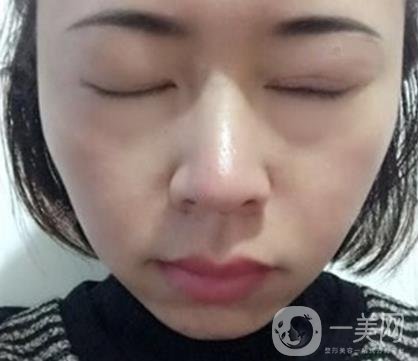 河南省立眼科醫(yī)院做上臉下垂怎么樣?價(jià)格表和真人*果圖展示