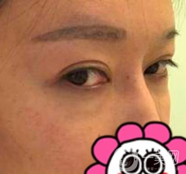 北京友誼醫(yī)院整形科祛眼袋*果好不好？2020年價格價目收費(fèi)曝光啦