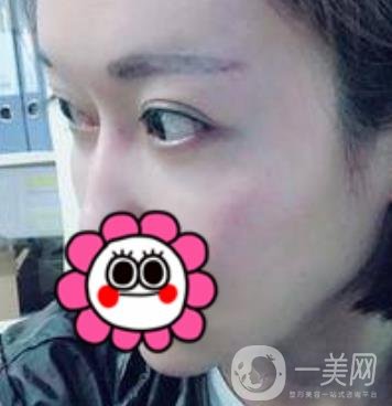 北京友誼醫(yī)院整形科祛眼袋*果好不好？2020年價格價目收費(fèi)曝光啦