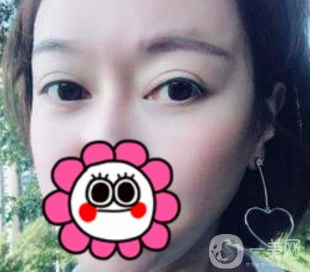 北京友誼醫(yī)院整形科祛眼袋*果好不好？2020年價格價目收費(fèi)曝光啦