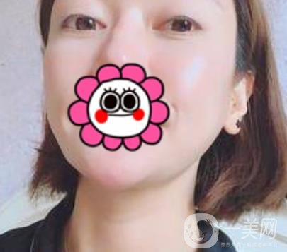 北京友誼醫(yī)院整形科祛眼袋*果好不好？2020年價格價目收費(fèi)曝光啦