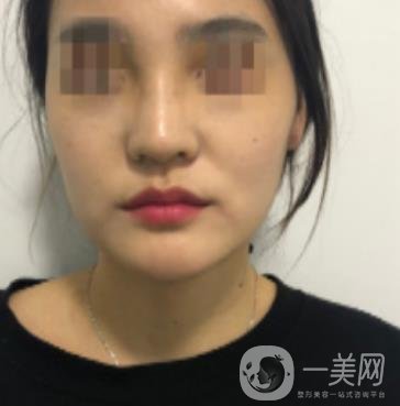 深圳人民醫(yī)院整形外科價目表，附隆鼻案例