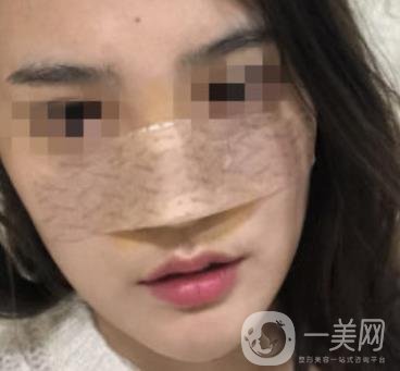 深圳人民醫(yī)院整形外科價目表，附隆鼻案例