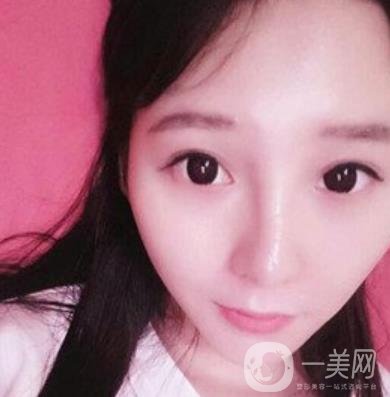 浙一醫(yī)院*誰打的好?附真人案例及整形價格表