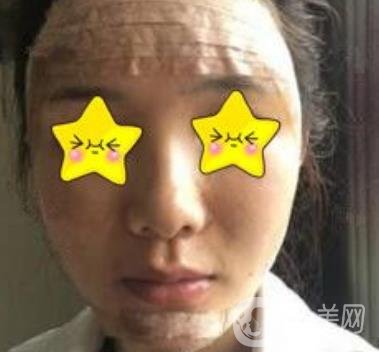 深圳北大醫(yī)院自體脂肪填充