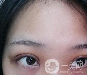 上海華美醫(yī)療美容醫(yī)院價格表，附雙眼皮修復(fù)案例