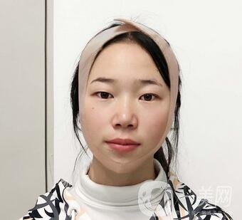 西安高一生醫(yī)療美容醫(yī)院價(jià)格表，附面部吸脂案例分享