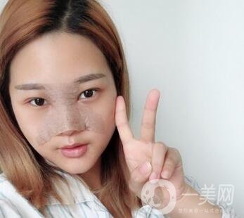 成都銅雀臺整形醫(yī)院隆鼻案例分享，附全新價格表