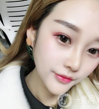 成都銅雀臺整形醫(yī)院隆鼻案例分享，附全新價格表