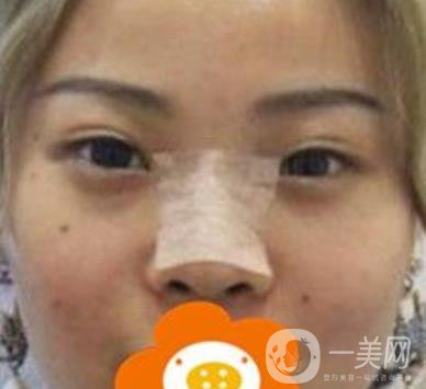 蚌埠美萊塢整形醫(yī)院玻尿酸隆鼻*果如何？價(jià)格表2020年收費(fèi)公布