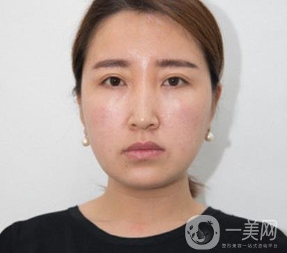 常州美貝爾整形美容醫(yī)院*注射多少錢？?jī)r(jià)格明細(xì)和*果圖展示