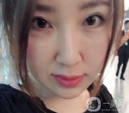 常州美貝爾整形美容醫(yī)院*注射多少錢？?jī)r(jià)格明細(xì)和*果圖展示