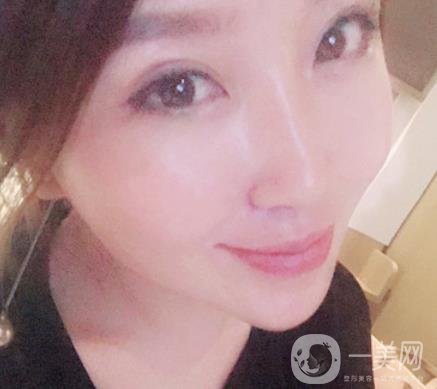 常州美貝爾整形美容醫(yī)院*注射多少錢？?jī)r(jià)格明細(xì)和*果圖展示