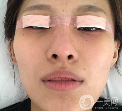 大連市中心醫(yī)院雙眼皮怎么樣？費(fèi)用是多少？真人恢復(fù)經(jīng)歷自述