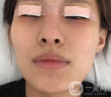 大連市中心醫(yī)院雙眼皮怎么樣？費(fèi)用是多少？真人恢復(fù)經(jīng)歷自述