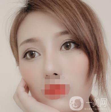 大連市中心醫(yī)院雙眼皮怎么樣？費(fèi)用是多少？真人恢復(fù)經(jīng)歷自述