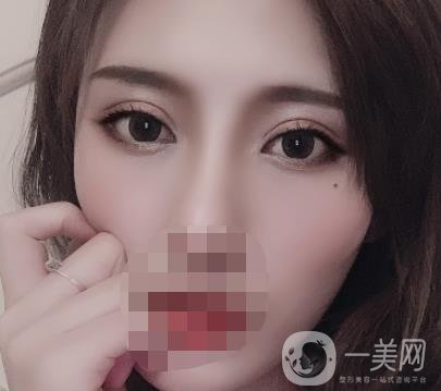 大連市中心醫(yī)院雙眼皮怎么樣？費(fèi)用是多少？真人恢復(fù)經(jīng)歷自述