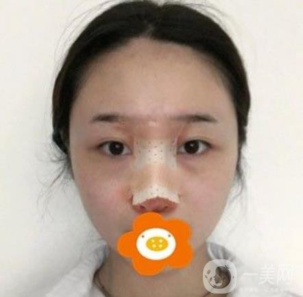 南京美貝爾整形醫(yī)院做*好不好？價格表費(fèi)用明細(xì)和*果圖參考