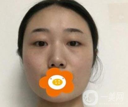 南京美貝爾整形醫(yī)院做*好不好？價格表費(fèi)用明細(xì)和*果圖參考