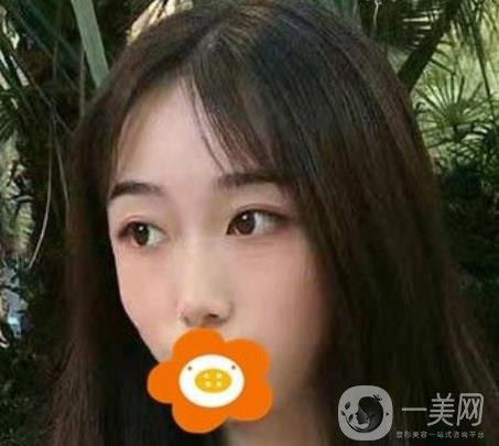 南京美貝爾整形醫(yī)院做*好不好？價格表費(fèi)用明細(xì)和*果圖參考