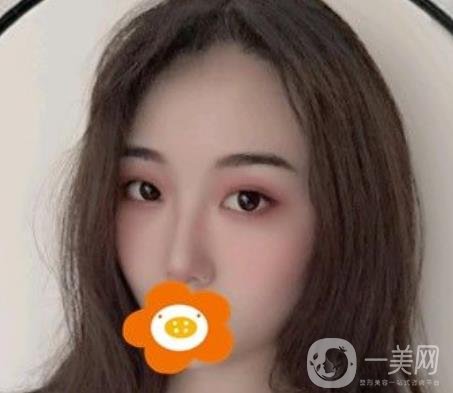 南京美貝爾整形醫(yī)院做*好不好？價格表費(fèi)用明細(xì)和*果圖參考