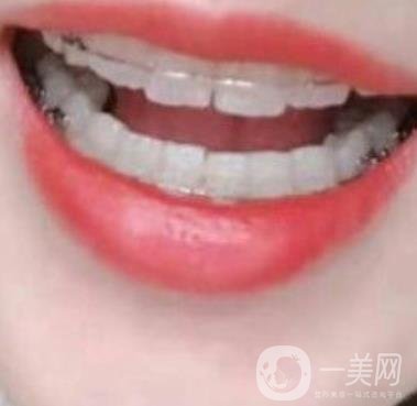 廣東省口腔醫(yī)院正畸價(jià)格表及案例恢復(fù)過程分享