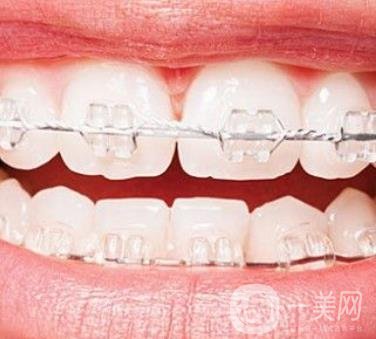 廣東省口腔醫(yī)院正畸價(jià)格表及案例恢復(fù)過程分享
