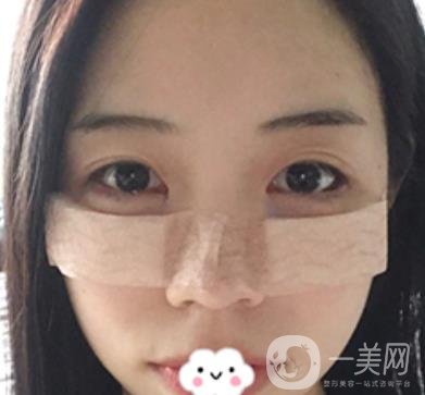 廣東省人民醫(yī)院整形科去眼袋怎么樣?內(nèi)含案例及價格一覽表