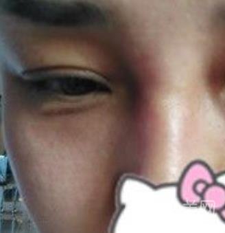 廣西醫(yī)科大一附院去眼袋怎么樣?整形價(jià)格表及案例*果圖分享