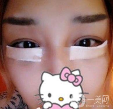 廣西醫(yī)科大一附院去眼袋怎么樣?整形價(jià)格表及案例*果圖分享