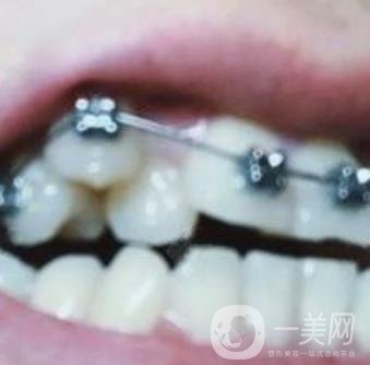 貴州口腔醫(yī)院正畸醫(yī)生信息介紹?內(nèi)含牙齒美容項目價格表及案例