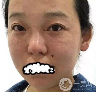 哈醫(yī)大四院整形美容科*新價格表公布,附祛斑真人案例